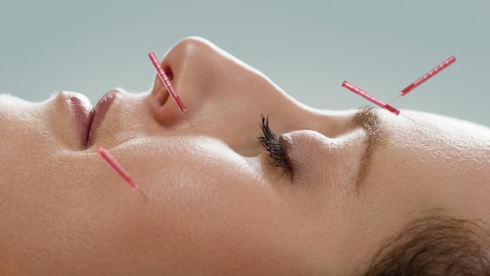 acupuncture-visage